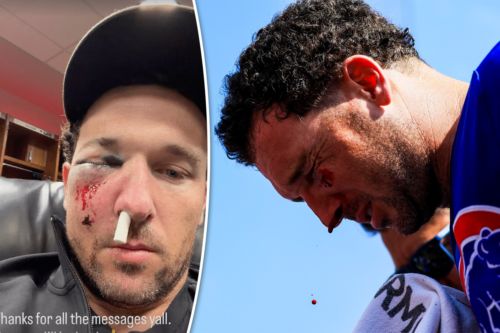 Alex Bregman could return quickly after getting face smashed by ball